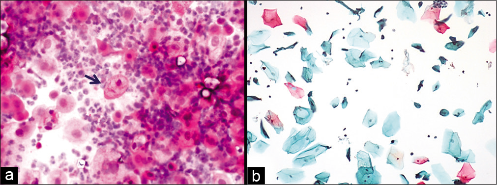 (a and b) Conventional smear showing multiple cytoplasmic vacuolation and LBC preparation showing a single large vacuole indenting the nucleus (×10).