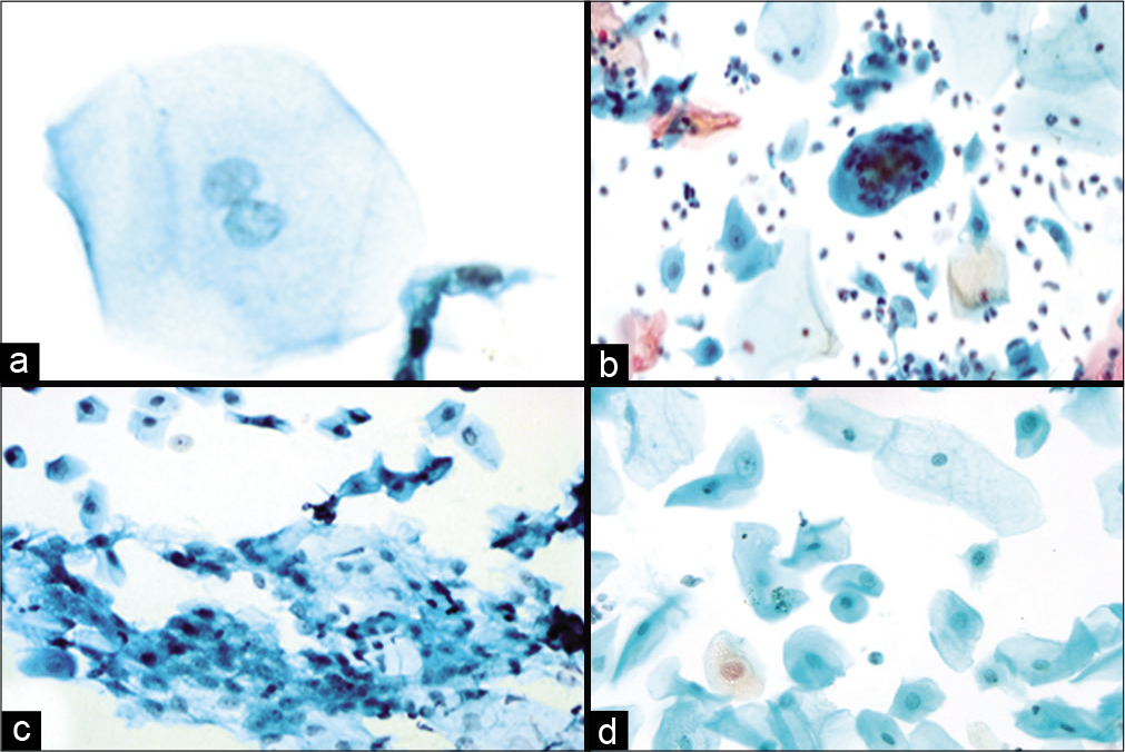 (a-d) LBC preparation showing binucleation (a, ×40), multinucleation (b, ×10), nuclear smudging (c, ×10), cellular gigantism with bland nucleus (d, ×10).