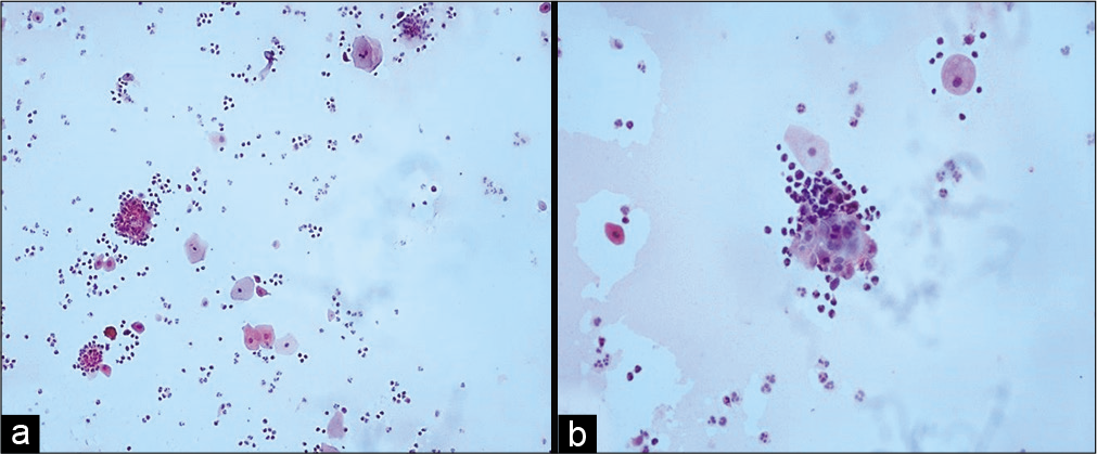 (a and b) Conventional smear showing pus balls, that is, invasion of epithelial cells by polymorphs (a-×10, b-×40).