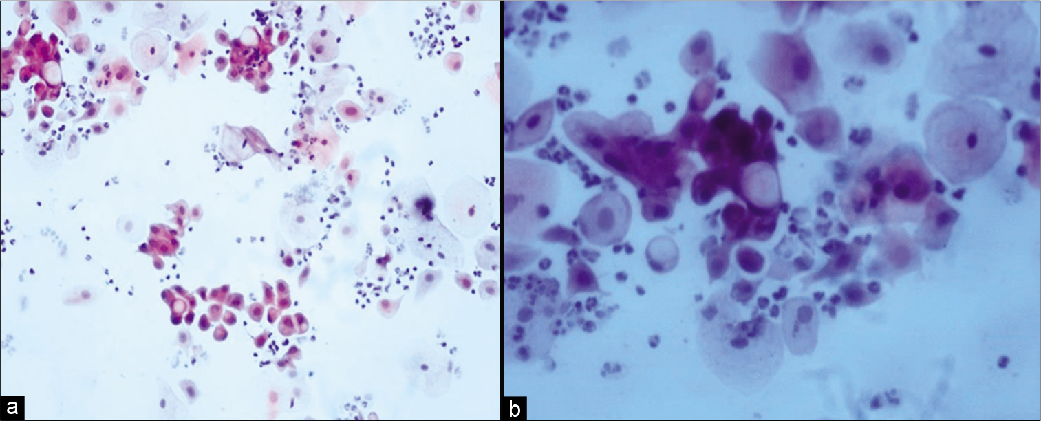 (a and b) Conventional Pap smear showing cytoplasmic vacuolation in malignant cells (a-×20, b-×40).