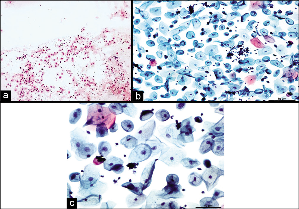 Conventional smear (a and b) showing chronic radiation changes in the form of atrophy in LBC preparation (c): Atrophic smear pattern in 45-year-old women 18 months after radiation (×10).