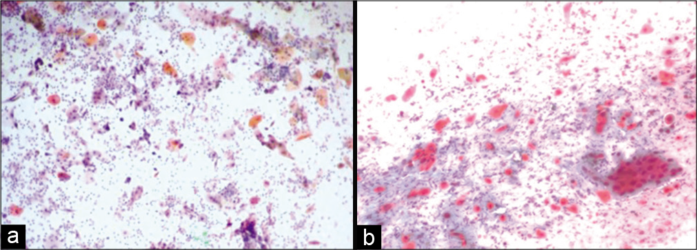 (a and b) Conventional smear from a patient with persistent carcinoma, malignant cells without radiotherapy effect (a-×10, b-×20).