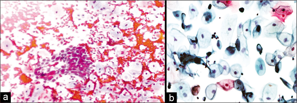 (a and b) Conventional smear: Recurrent squamous cell carcinoma 10 months after radiation therapy in a 45-year-old woman (×10).