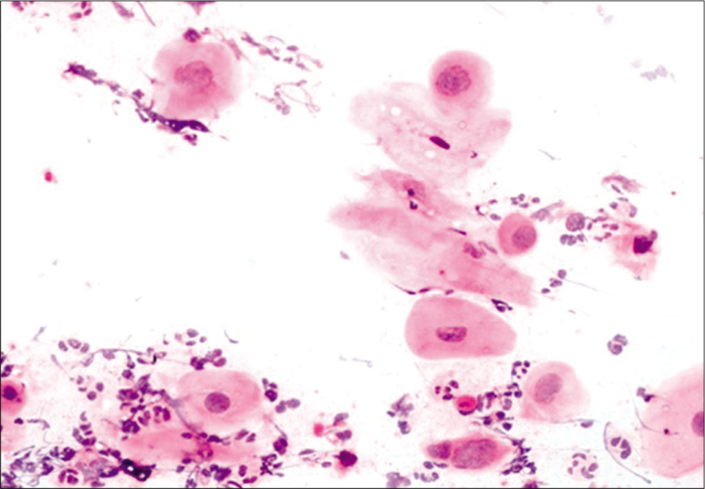 LBC preparation: Cells showing post-radiation dysplasia in the lower half of the field.