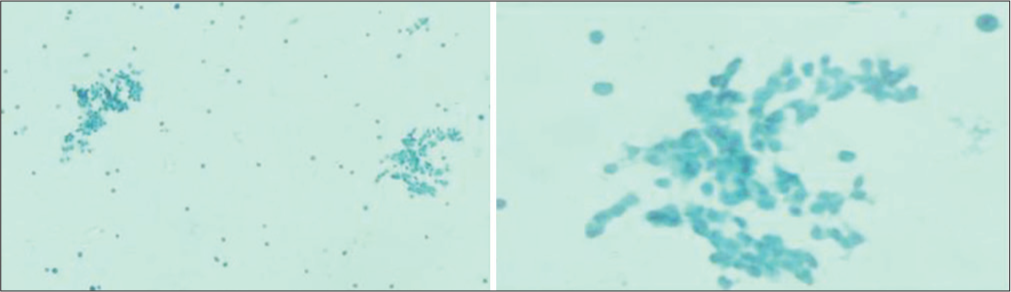 Liquid-based cytology preparation showing clearer background and better nuclear morphology of thyroid follicular cells as compared to conventional FNA smears.