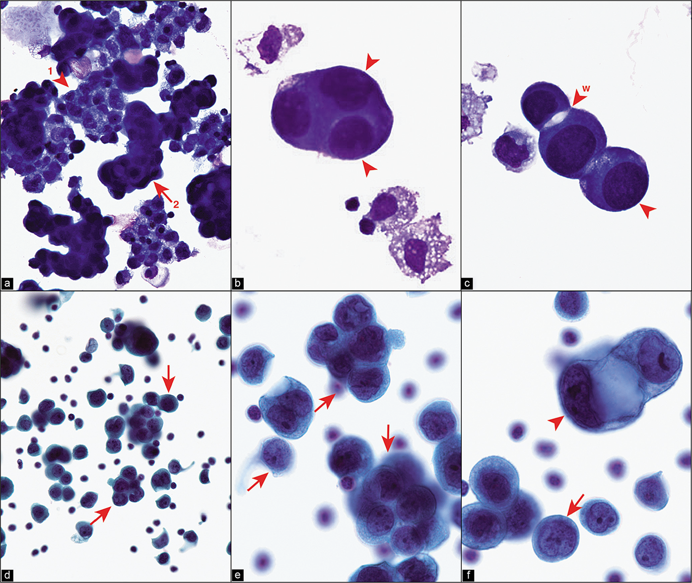 Metastatic poorly differentiated adenocarcinoma of lung, pleural fluid. The DQ-stained preparation (a) demonstrates reactive mesothelial cells (arrowhead 1 in a) mixed with a ‘second population’ of cohesive groups of cells (arrow 2 in a) with eccentric nuclei that touch the periphery of the carcinoma cells (arrowheads in b,c,f). Some cells are less cohesive seen as scattered small groups or solitary carcinoma cells (arrows in d–f). Occasional intercellular spaces, resembling mesothelial windows may be present (arrowhead w in c). The patient had poorly differentiated adenocarcinoma of the lung. [a–c, DQ-stained Cytospin smear; d–f, PAP-stained SurePath smear (a, 10X; b,c, 100X; d, 10X; e,f, 100X).]