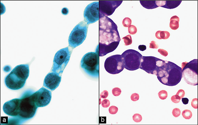 Metastatic ovarian adenocarcinoma, peritoneal fluid. The neoplastic cells show an Indian-file pattern. This arrangement is not specific for small cell carcinoma of lung [Figure 6] and may be seen in other non-small-cell carcinomas including metastatic ovarian and mammary adenocarcinoma. [a, PAP-stained SurePath smear; b, DQ-stained Cytospin smear (a,b, 100X).]