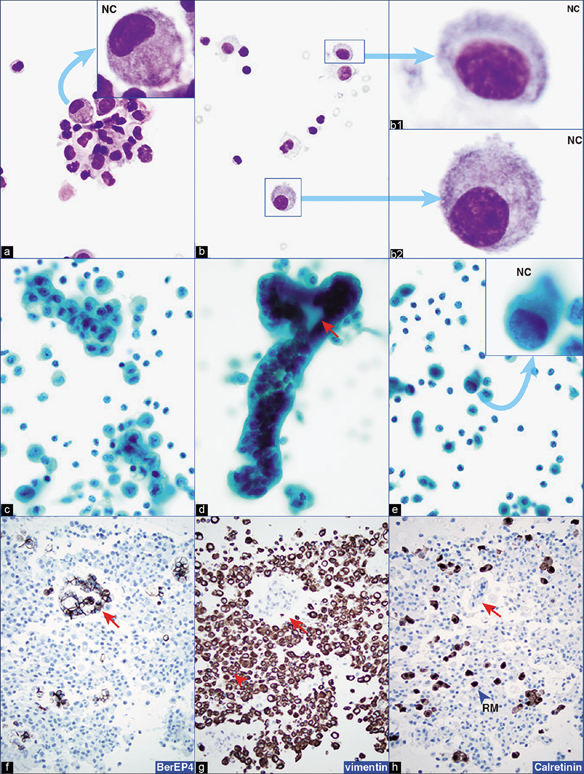 Metastatic pancreatic adenocarcinoma, peritoneal fluid. The neoplastic cells (NC) are seen as loosely cohesive groups (a) or as solitary cells (b,e) with eccentric nuclei. PAP-stained preparations facilitate evaluation of cellular details in cohesive groups (c,d). A few cell groups show gland-like structures (arrow in d). ‘A second population’ (arrows in f–h) of neoplastic cells is highlighted distinctly in immunostained cell-block sections f–h (the neoplastic cells are immunoreactive for BerEP4 in f, non-immunoreactive for vimentin in g, and calretinin in h). As inbuilt corresponding positive controls, inflammatory and reactive mesothelial cells (arrowhead in g) are immunoreactive for vimentin and reactive mesothelial cells (arrowhead RM in h) are immunoreactive for calretinin. The patient had pancreatic adenocarcinoma. NC, neoplastic cell; RM, reactive mesothelial cell. [a,b, DQ-stained Cytospin smear; c–e, PAP-stained SurePath smear; f–h, immunostained cell-block sections (a–e, 100X; f–h, 40X).]