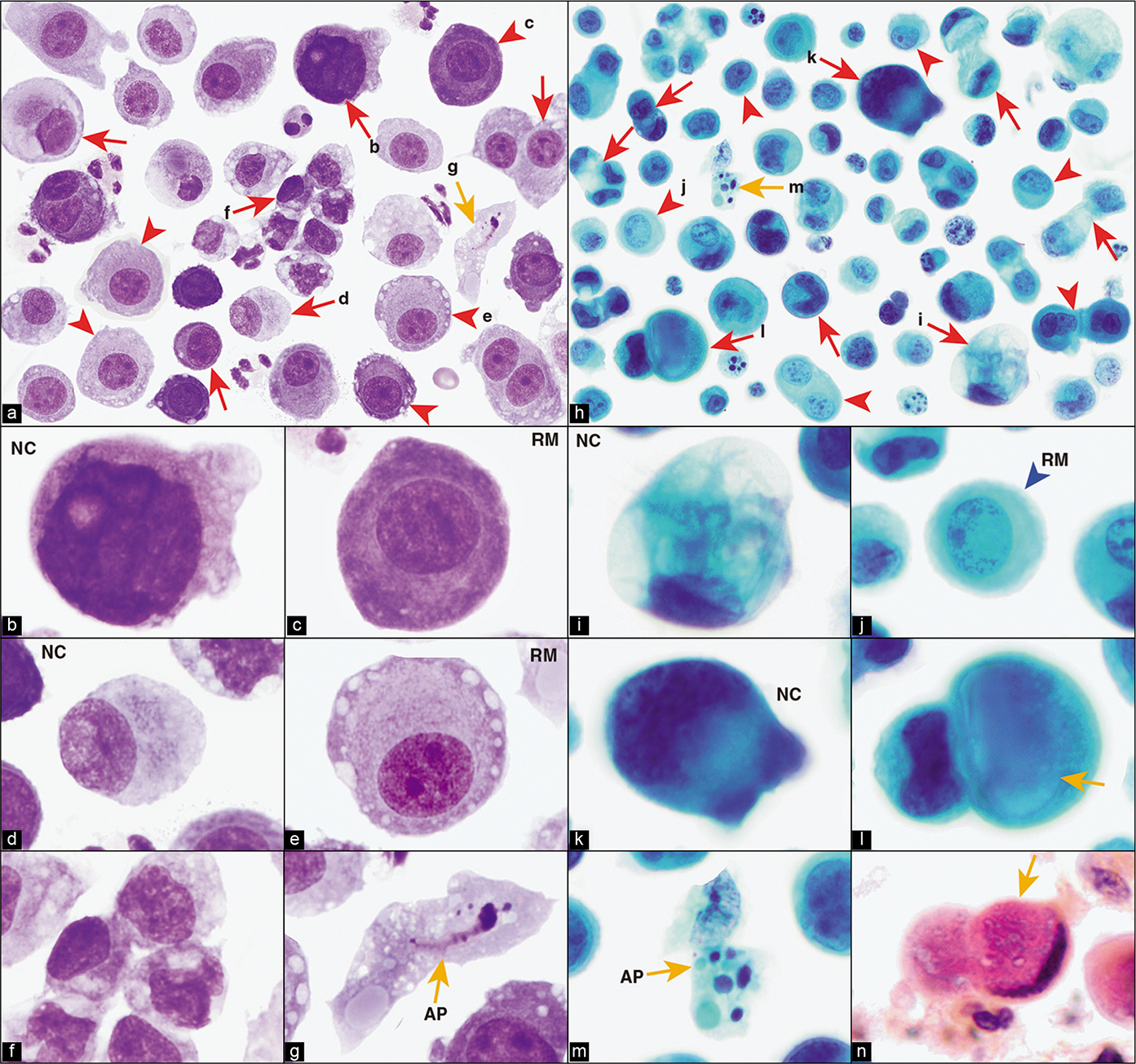 Metastatic cholangiocarcinoma, peritoneal fluid. Cancer cells (red arrows in a,h) are present mostly as solitary cells with eccentric nuclei touching the periphery of the cells (b,d,i,k,l) with occasional loosely cohesive groups of cancer cells (a,f) and reactive mesothelial cells (c,e,j and arrowheads in a,h). A few cells show cytoplasmic vacuoles (i) with secretion (yellow arrow in l), which is positive for mucicarmine in cell-block sections (n). Some apoptotic cancer cells (yellow arrow AP) are also present (g,m). The morphologic features overlap those of other mucinous adenocarcinomas. The patient had cholangiocarcinoma with a mucinous pattern. AP, apoptotic cancer cell; NC, neoplastic cell; RM, reactive mesothelial cell. [a–g: DQ-stained Cytospin smear; h–m, PAP-stained SurePath preparation; n, mucicarmine-stained cell-block section. (a, 100X; b–g, 100X zoomed; h, 100X; i–m, 100X zoomed; n, 100X zoomed).]
