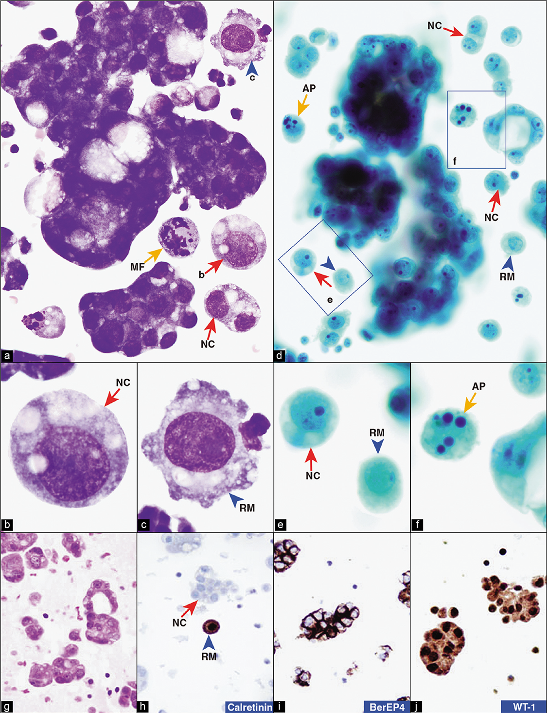 Primary peritoneal carcinoma, peritoneal fluid. The specimen shows a predominance of adenocarcinoma cells in papillary configurations (a,d) without stromal cores (g). Solitary neoplastic cells (red arrows NC in a,b,d,e) are easily distinguished from the rare reactive mesothelial cells (blue arrowheads RM in c,d,e). However, in PAP-stained preparation (d), reactive mesothelial cells (arrowhead RM in e) have significant morphologic overlap with neoplastic cells (red arrows NC in d,e). Mitotic figures (yellow arrow MF in a) and apoptotic cells (yellow arrows AP in d,f) are present concurrently. Some cells show degenerative vacuolation (a,b). These vacuoles may resemble secretory vacuoles and lead to misinterpretation as mucinous adenocarcinoma. The cancer cells do not show nuclear immunoreactivity for calretinin (h), but they are immunoreactive for BerEP4 (i). The neoplastic cells show nuclear (and cytoplasmic) immunoreactivity for WT-1(j). The patient had ascites with diffuse peritoneal involvement with omental caking. The ovaries were not enlarged. AP, apoptotic cancer cell; MF, mitotic figure; NC, neoplastic cell; RM, reactive mesothelial cell. [a–c, DQ-stained Cytospin smear; d–f, PAP-stained SurePath smear; g, HE-stained cell-block section; h–j, immunostained cell-block sections (a, 100X; b,c, 100X zoomed; d, 100X; e,f, 100X zoomed; h–j, 100X).]