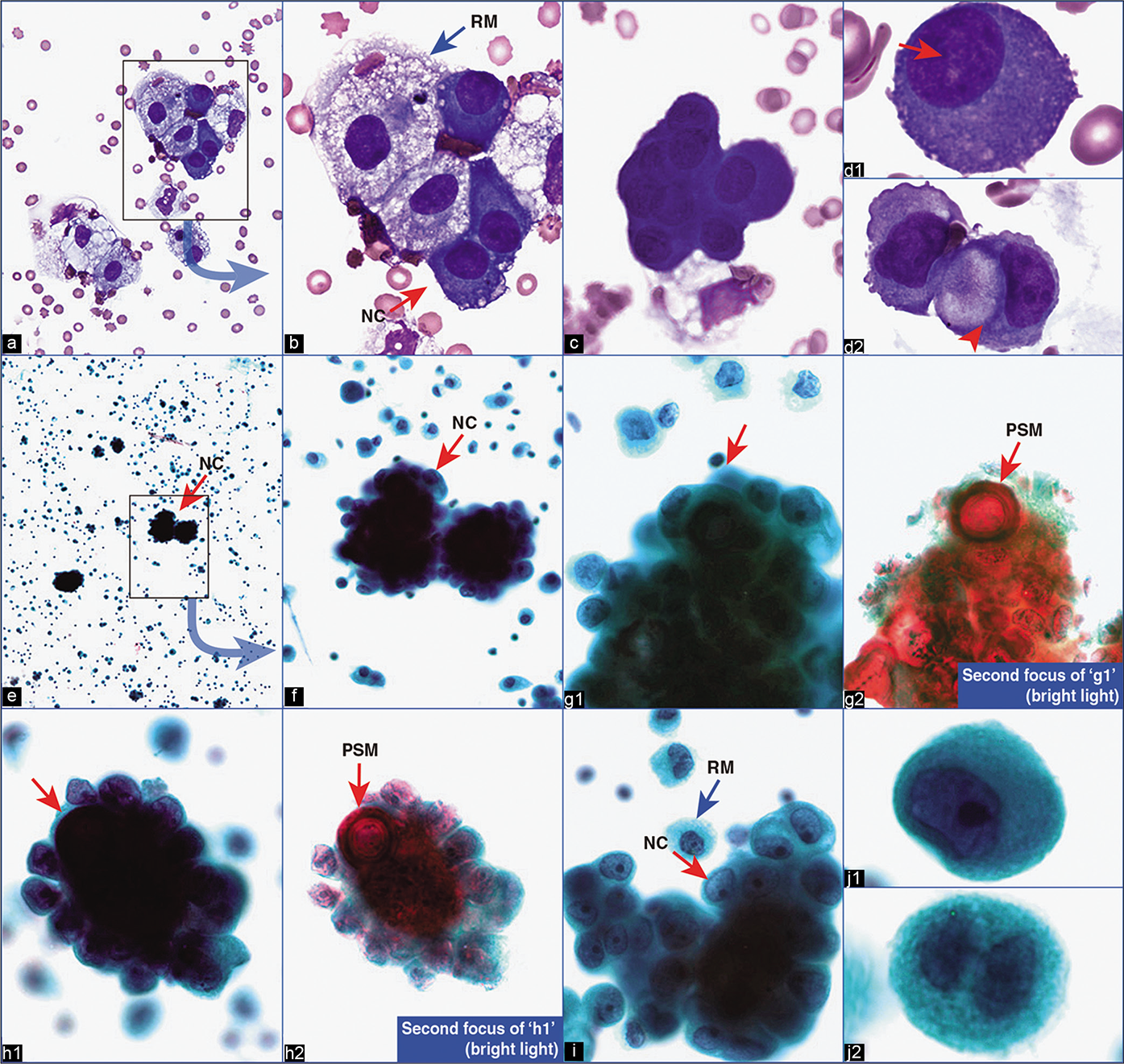 Metastatic papillary carcinoma of thyroid, pleural fluid. ‘Second population’ of cohesive papillary groups (red arrows NC in b,e,f) of cells associated with psammoma bodies with concentric lamination (red arrow PSM in g2,h2) are seen amongst a few reactive mesothelial cells (blue arrow RM in b,i). d1, single tumor cells with eccentric nuclei touching the periphery (red arrow) in DQ-stained preparation. d2, single cells may have cytoplasmic vacuoles with colloid (arrowhead) in DQ-stained preparation. j1, single tumor cells with eccentric nuclei in PAP-stained preparation. j2, compare with reactive mesothelial cell (binucleate) with central nuclei in PAP-stained preparation. The patient had papillary carcinoma of thyroid. NC, neoplastic cell(s); PSM, psammoma body; RM, reactive mesothelial cell(s). [a–d, DQ-stained Cytospin smear; e–j, PAP-stained SurePath smear. (a, 40X; b,c, 100X; d1,d2, 100X zoomed; e, 10X; f, 40X; g1,g2,h1,h2,i, 100X; j1,j2, 100X zoomed).]