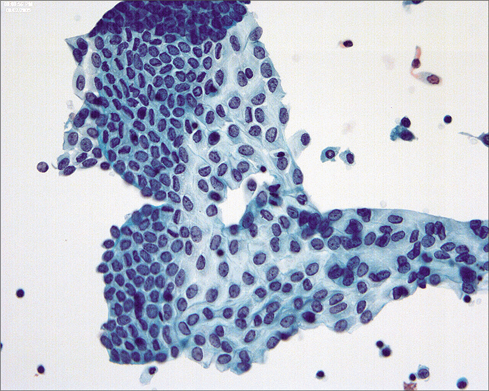 The mesothelial sheets are subject to distortion so that the nuclear-cytoplasmic ratio can show considerable variation in reactive mesothelial cells. (Modified PAP stain, 40X.)