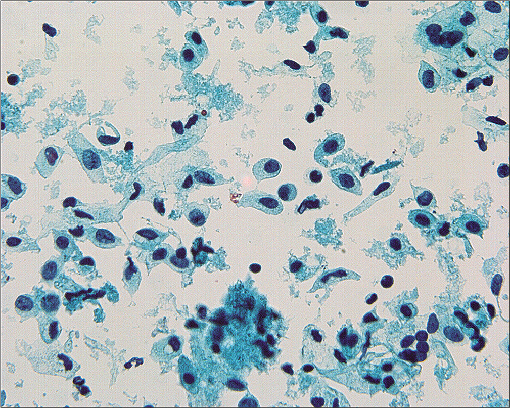 In some cases, the mesothelial cells are found as predominantly single cells. (Modified PAP stain, 60X.)