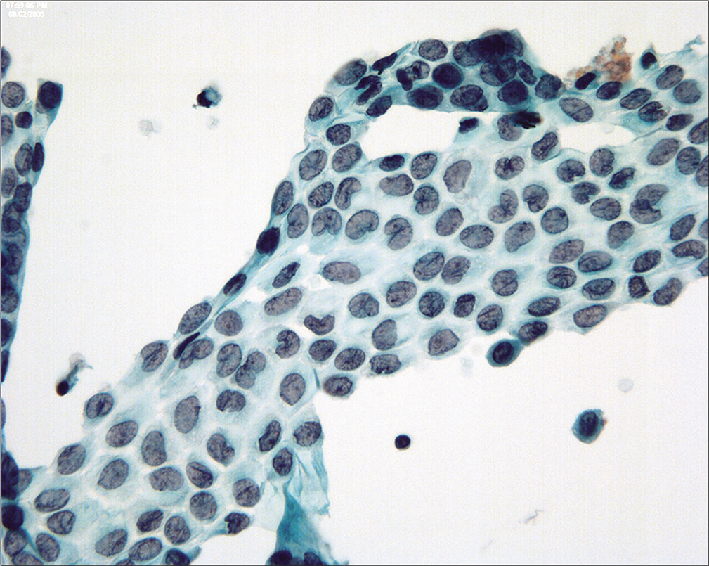 Although generally round-oval, mesothelial nuclei in these samples can sometimes appear bi-lobated and multi-lobated. Some nuclei also show longitudinal grooves. (Modified PAP stain, 60X.)