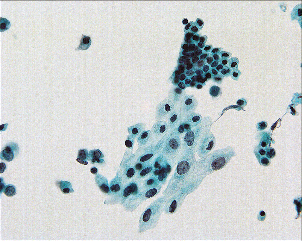 Nuclear size in mesothelial cells can vary considerably in peritoneal washings and it is important not to overcall in such cases. All of the cells in this field are reactive. (Modified PAP stain, 60X.)