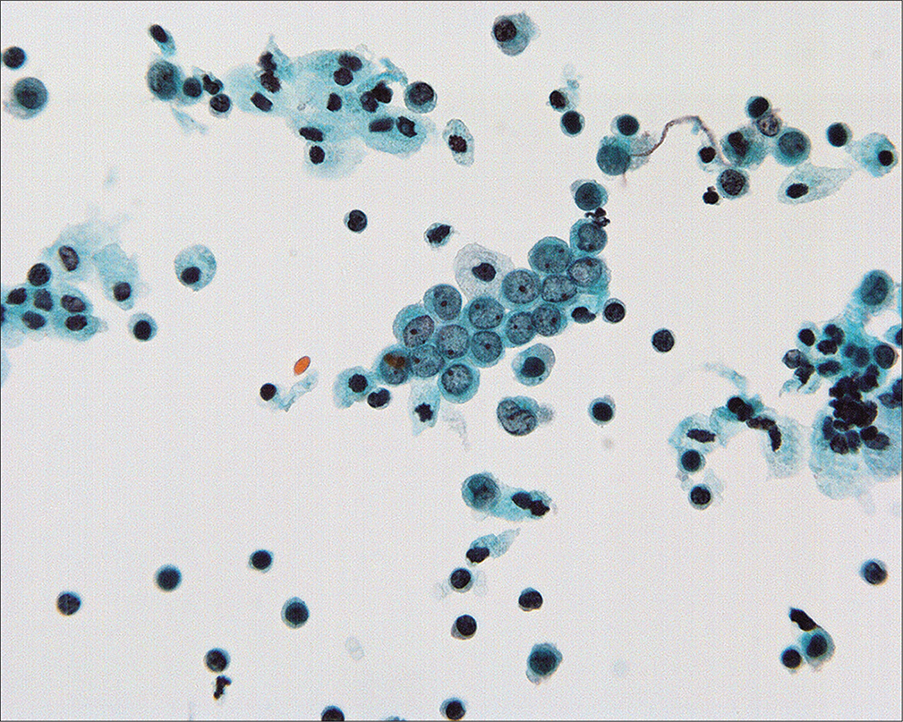 Normal mesothelial cells with well-preserved round-oval nuclei, finely granular chromatin, and single small nucleoli. (Modified PAP stain, 60X.)