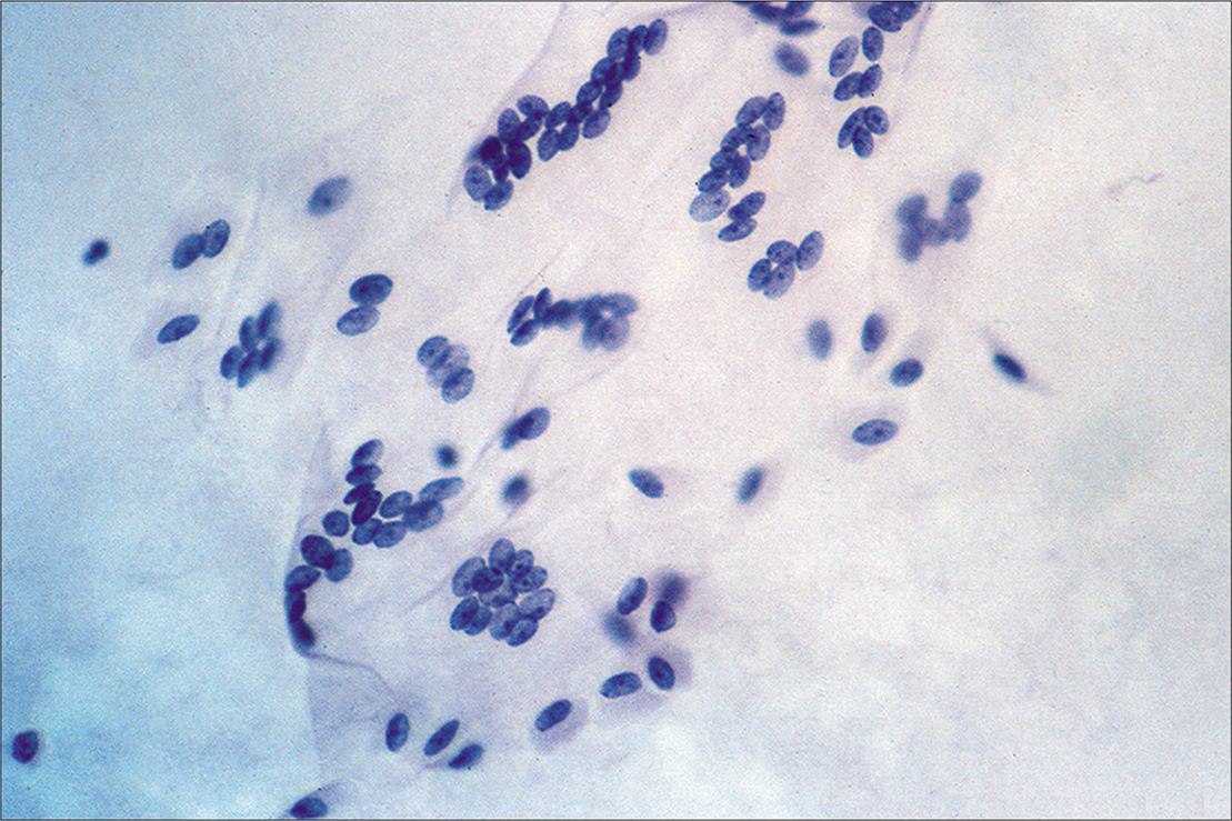 Multinucleated mesothelial cell sheets can sometimes be seen, generally against a background of previous laparotomy or other mesothelial injury. (Modified PAP stain, 20X.)