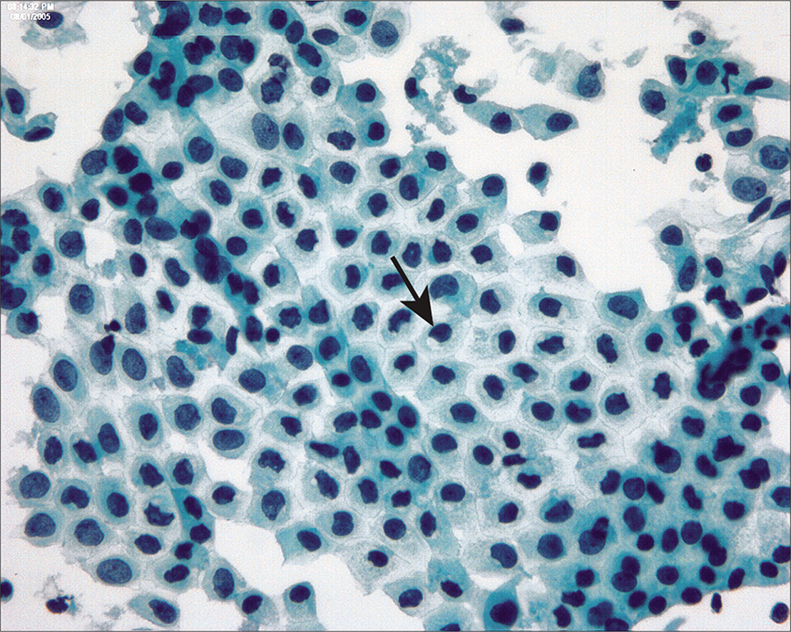 Paranuclear vacuoles develop in degenerating mesothelial cells that may alter nuclear contours (arrow). (Modified PAP stain, 60X.)