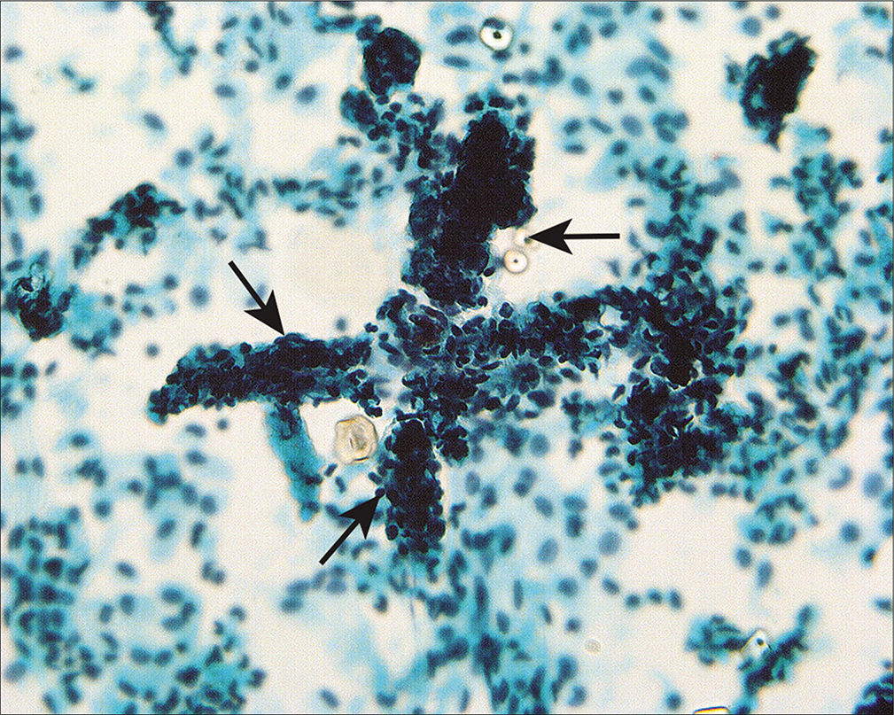 Structures composed of tangled fibrillary material (arrows) appear to represent capillaries and associated connective tissue material that reflect lysed adhesions. This pattern can be seen associated with healed inflammation or endometriosis. (Modified PAP stain, 60X.)