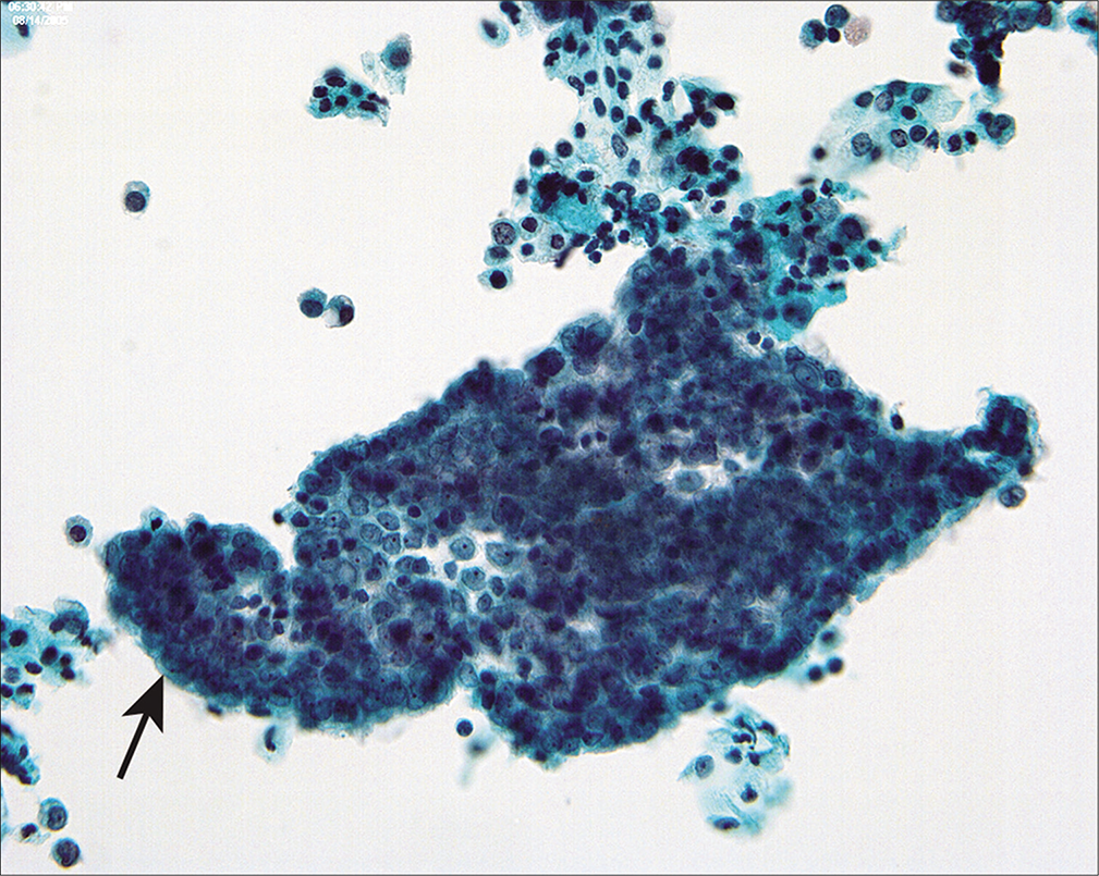 Mesothelial sheets associated with large ovarian fibromas and spontaneous peritoneal fluid can have a rolled-up, pseudopapillary appearance (arrow). (Modified PAP stain, 40X.)