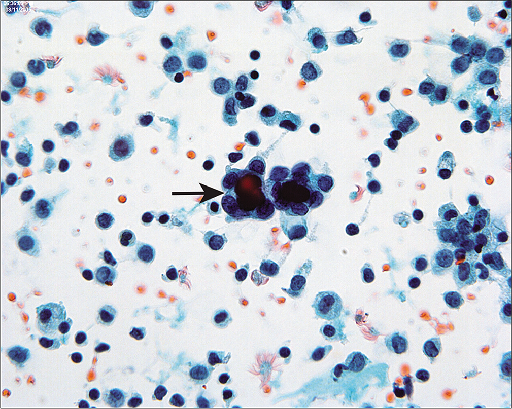 Psammoma bodies are surrounded by cuboidal epithelium (arrow). This pattern is typical of endosalpingiosis, although it can be seen with low-grade serous tumors. Typically in the latter instance, multiple abnormal cell groups will be present, with or without psammoma bodies. If only one or two groups are present (as seen in this case), they are unlikely to represent peritoneal extension of a serous carcinoma, although review of the histology is often helpful. (Modified PAP stain, 60X.)