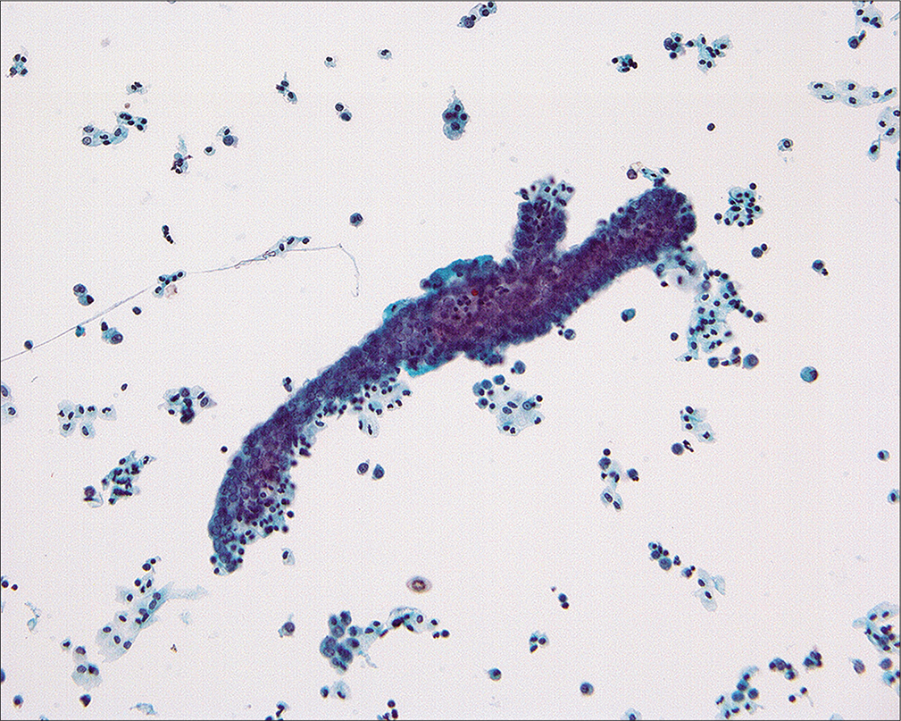 Cast-like groups that appear to have been removed as a unit from an irregular ovarian surface have been found in association with benign tumors, particularly adenofibromas. Although they can occasionally be found in the peritoneal washings of women with malignant tumors, the diagnosis of malignancy should only be made in cases that have other cells or groups with the typical features of malignancy. (Modified PAP stain, 20X.)