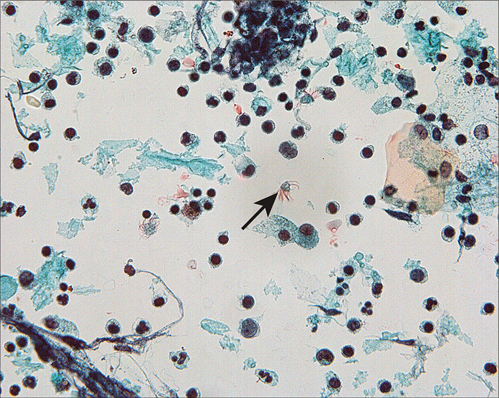 Detached ciliary tufts (arrow) are seen as anucleated cell fragments composed of cilia and a small fragment of residual cytoplasm. (Modified PAP stain, 60X.)