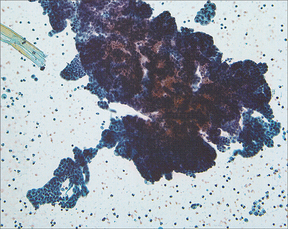 A large fragment of tumor cells can be dislodged from intraperitoneal malignancy in the course of taking the washings. This pattern is rare in spontaneous effusions. (Modified PAP stain, 20X.)