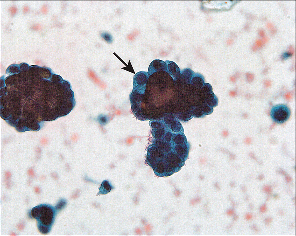 Groups of abnormal cells surrounding psammoma bodies (arrow) in a washing from a woman with an ovarian serous borderline tumor involving the peritoneal cavity. The large number of abnormal cells and groups suggested that the process was neoplastic rather than endosalpingiosis. The histologic comparison easily confirmed the neoplastic process. (Modified PAP stain, 60X.)