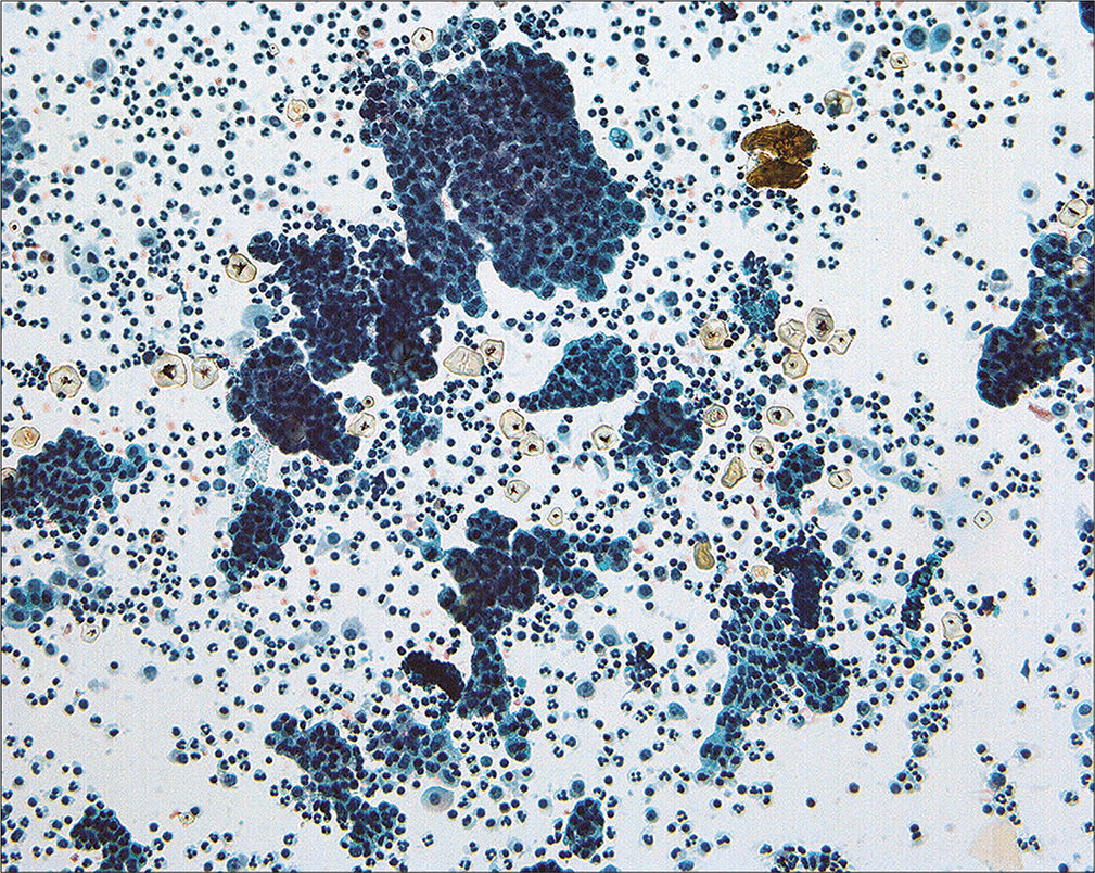 Groups of atypical cells interpreted as ‘low-grade serous tumor’ are present in this washing from a woman with intraperitoneal micropapillary serous tumor. While the cytologic pattern is that of a neoplasm, the precise categorization is difficult by cytology alone. Indeed, it is unclear whether this lesion is a well-differentiated carcinoma or a tumor of low malignant potential (borderline). (Modified PAP stain, 20X.)