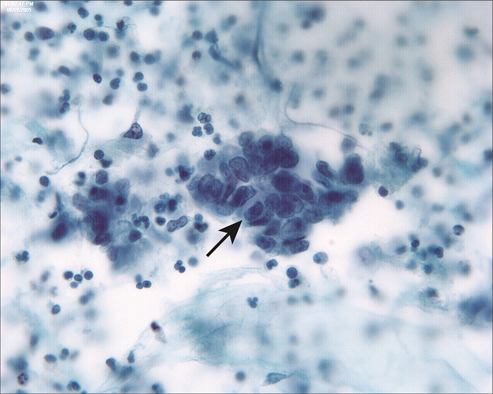 Endometrioid carcinoma of the endometrium typically involves the peritoneal cavity late in the disease, accompanied by deep myometrial invasion, vascular space invasion, and peritoneal tumor implants. In this case of low-grade endometrioid adenocarcinoma of the endometrium, tumor penetrated to the serosal surface and involved pelvic structures. In this three-dimensional group (arrow), the columnar cells are haphazardly arranged with dyspolaric nuclei. This latter feature helps to distinguish endometrioid carcinoma from tubal epithelium. (Modified PAP stain, 60X.)