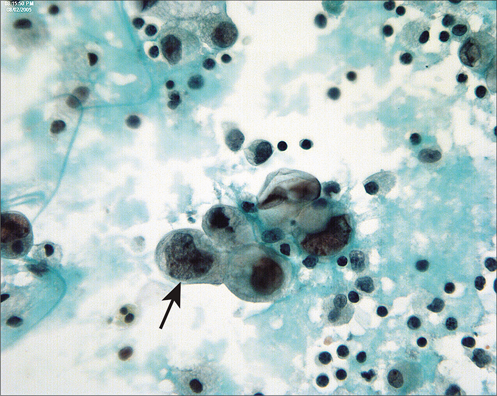 Serous carcinoma of endometrium in peritoneal washings are typically seen as three-dimensional groups and single cells with large nuclei and prominent nucleoli. Unlike endometrioid adenocarcinomas, peritoneal involvement is common and the abnormal cells are readily recognized as malignant (arrow). (Modified PAP stain, 60X.)