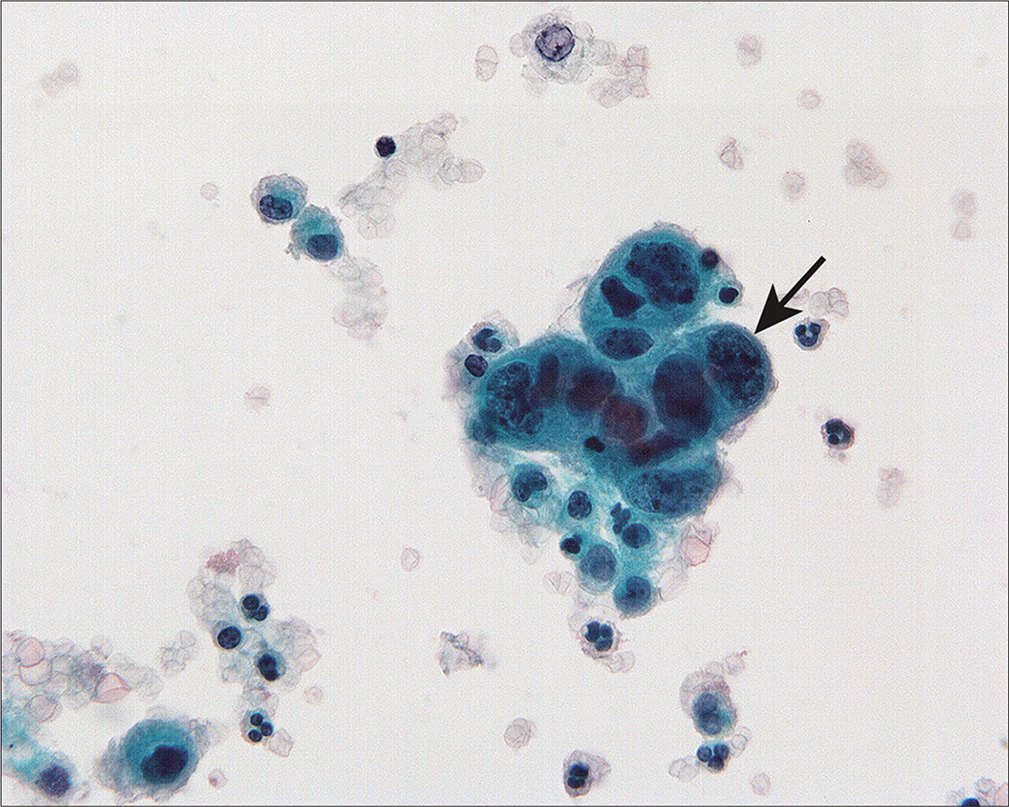 Cervical squamous carcinoma can be seen as three dimensional groups or single cells in peritoneal washings. This group of nonkeratinizing squamous carcinoma cells shows enlarged nuclei and increased nuclear-cytoplasmic ratio (arrow). Unless the histologic type is known, it is possible to overlook non-keratinizing squamous carcinoma as reactive mesothelial cells. (Modified PAP stain, 60X.)