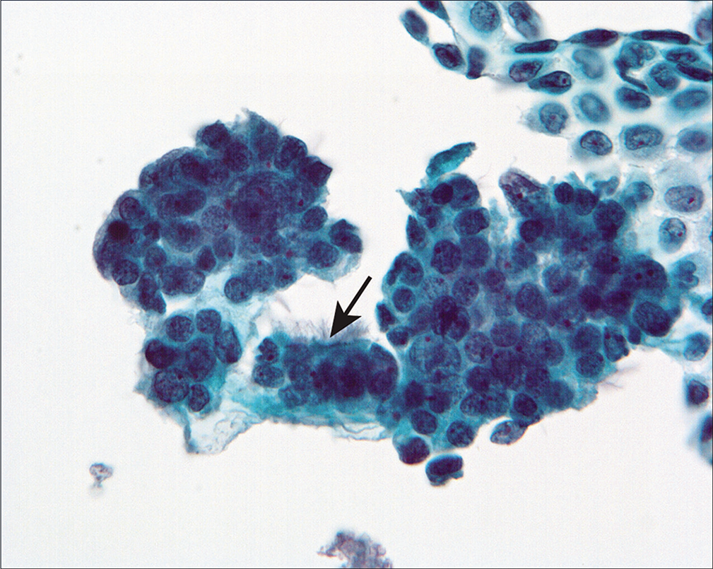 Three-dimensional cell groups are present, associated with a sheet of mesothelial cells. Some of the cells showed cilia (arrow). (Modified PAP stain, 40X.)