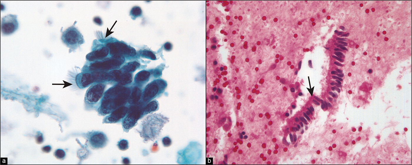 (a) Higher-power view of abnormal cell cluster with cell crowding, increased nuclear size, clumped chromatin, prominent small nucleoli. Cilia (arrows) are prominent. (Modified PAP stain, 60X.). (b) Strip of columnar cells in the cell block, some of which show cilia (arrow). (HE, 60X.)