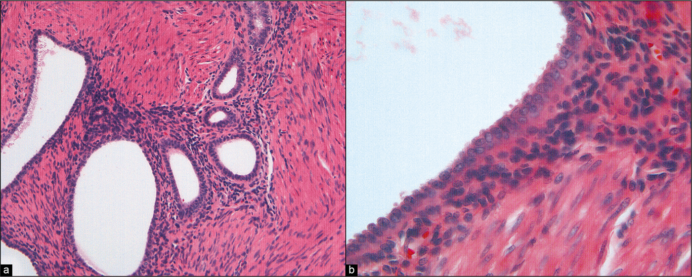 (a) Histologic section of a peritoneal biopsy from this patient showing endometriosis, including endometrial stroma. (HE, 20X.). (b) Higher-power view of columnar epithelium lining an endometriotic cyst. (HE, 60X.)