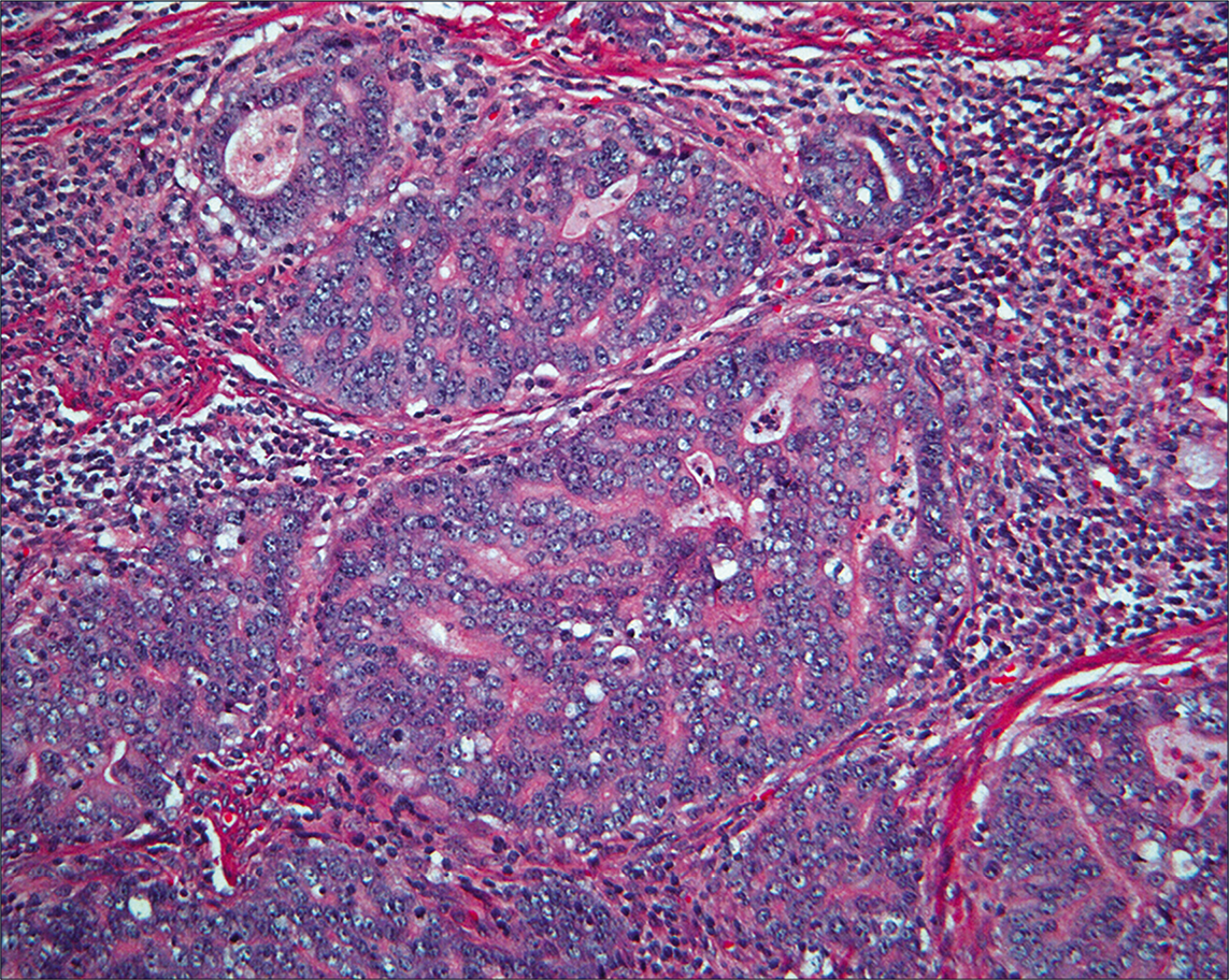 Histology of the endometrial carcinoma shows an endometrioid pattern with an open chromatin pattern and prominent nucleoli. (HE, 10X.)