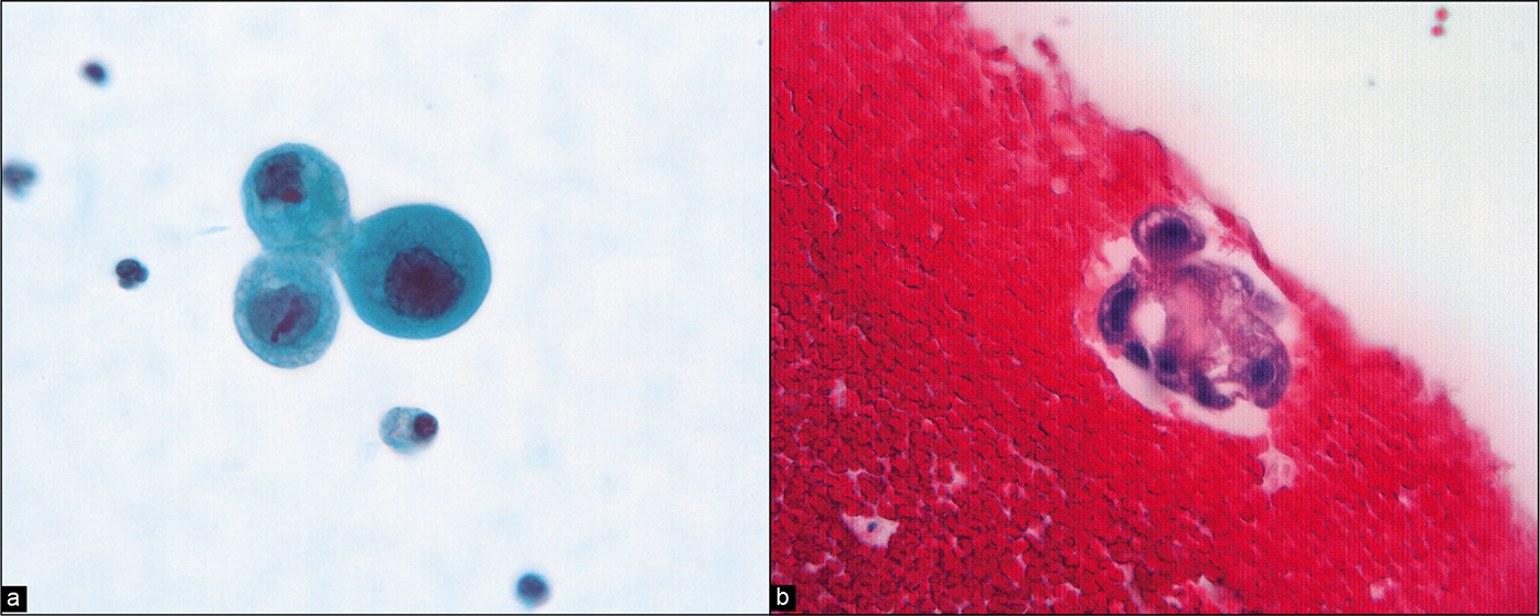 (a) Higher-power view of isolated atypical cells with rounded shape, enlarged irregular nuclei, and prominent nucleoli. (Modified PAP stain, 60X.). (b) A similar cell group is present in the cell block. (HE, 60X.)