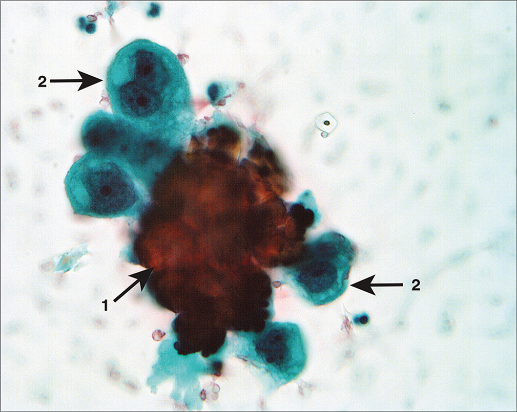 Atypical cell aggregate associated with microcalcification (arrow 1). The cells have a hobnail shape with enlarged nuclei and prominent large nucleoli (arrows 2). Despite the sparse number of cells in the sample, these cells were interpreted as neoplastic. (Modified PAP stain, 40X.)