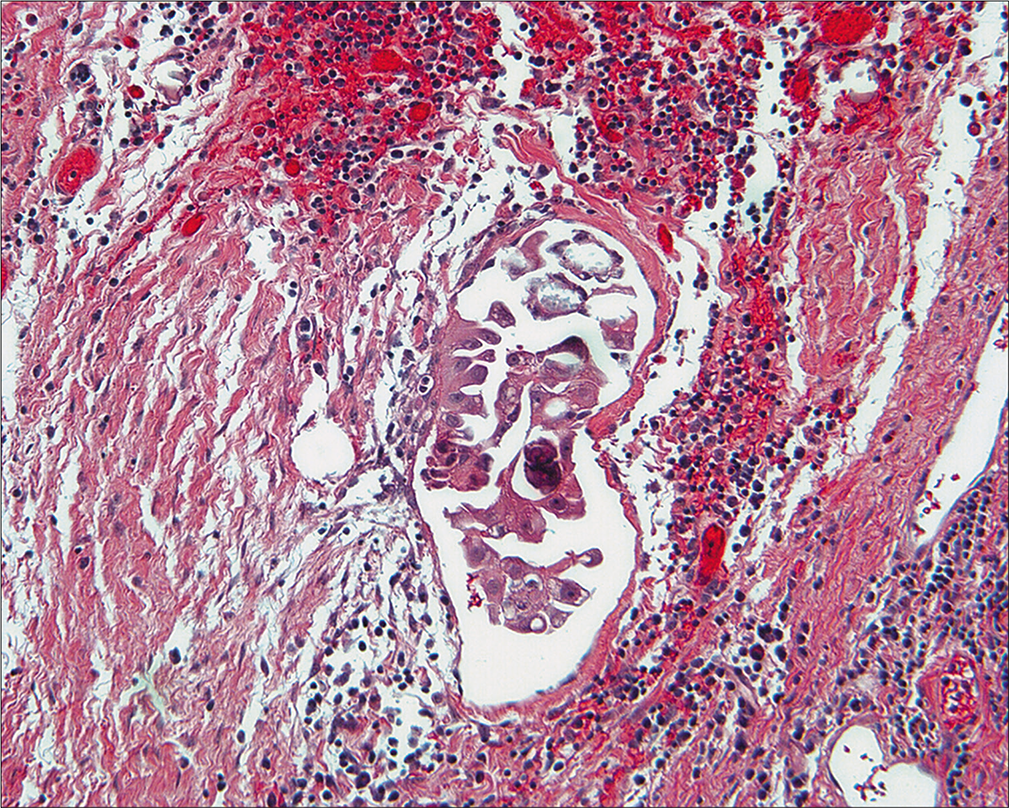 Histologic section of non-invasive implant of low-grade serous tumor. These cells compare well with the cytology. (Peritoneal biopsy at re-exploration; HE, 10X.)