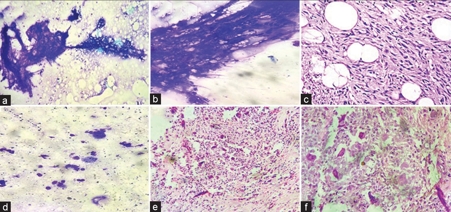 Benign mesenchymal lesion (a-c) May Grunwald Giemsa stained smears show admixture of mature adipocytes and uniform spindle cells. Hematoxylin and eosin stained sections exhibit the triad of mature adipocytes, bland spindle cells and hyalinized rope-like collagen fibres confirming the diagnosis of spindle cell lipoma (×200 magnification). (d-f) May Grunwald Giemsa stained smears show mononuclear stromal cells with oval to spindle shaped nuclei and osteoclast type giant cells confirmed on histology (Hematoxylin and eosin)- Giant cell tumour of tendon sheath (×100, ×200 magnification).