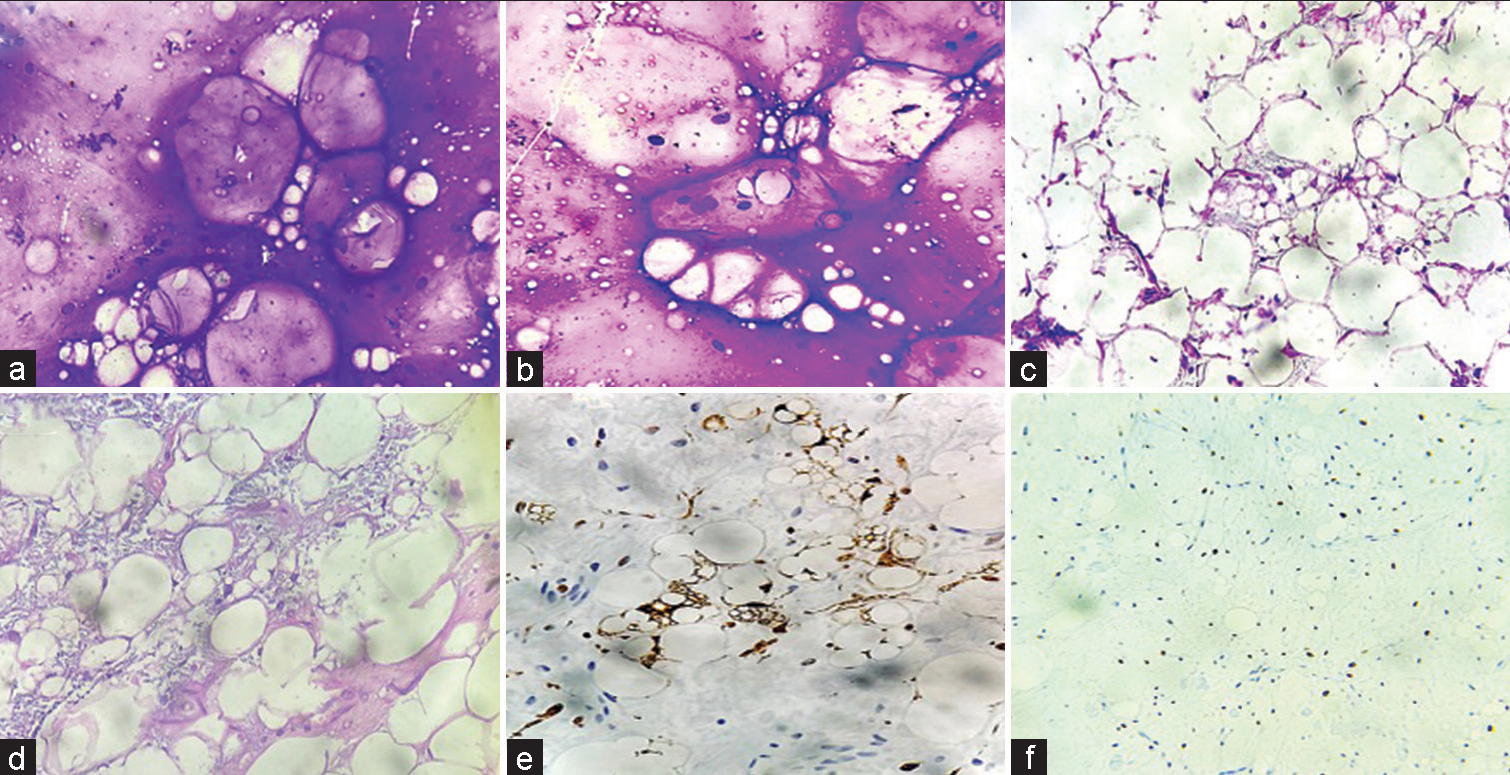 (a and b) May Grunwald stained smears show abundant metachromatic, myxoid stroma with vacuolated cells. (c and d) Hematoxylin and eosin stained sections show lipoblasts within a myxoid stroma. (e and f) Immunohistochemistry exhibiting positive expression of S-100 in the lipoblasts with Ki67 proliferation index of 30% confirming the diagnosis of Myxoid liposarcoma (×200 magnification).