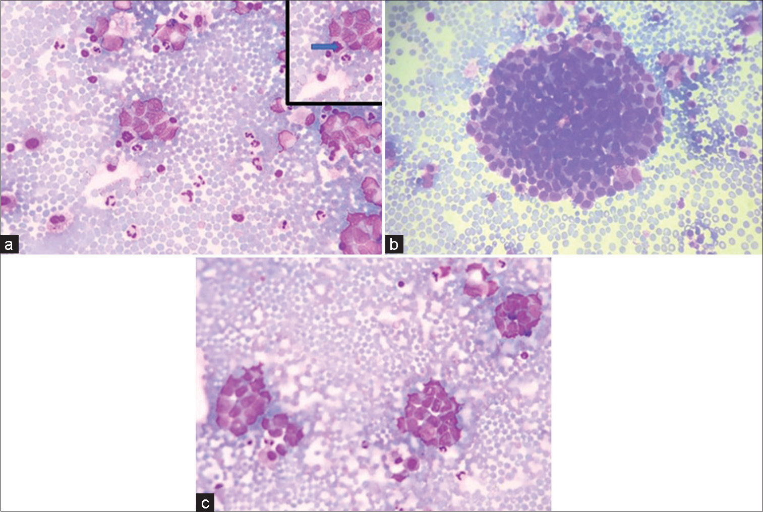 (a-c) (GIEMSA ×40) Smears showing tumor cells in clusters and singly scattered having high N:C ratio and opened up chromatin and pleomorphism. (a) Inset shows atypical mitoses pointed by solid arrow.