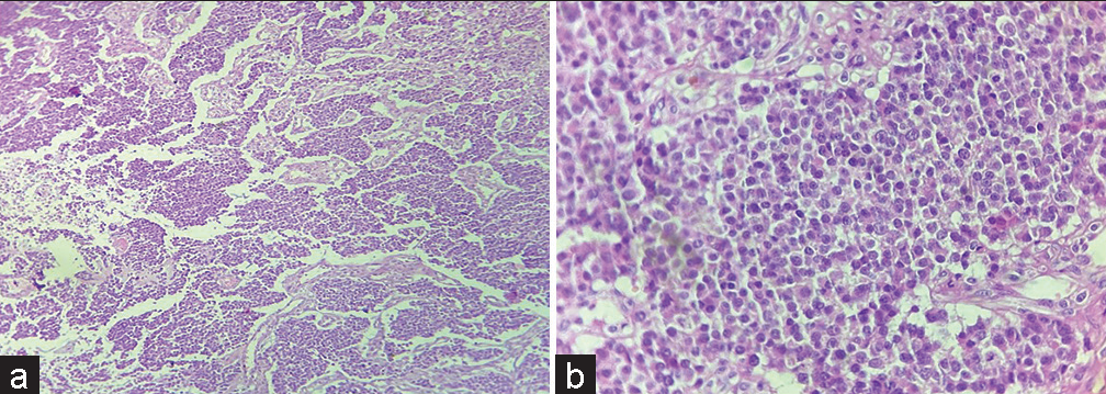 (a) Tumor cells arranged in nest, chords and trabeculae (H & E ×10); (b) Tumor cells having round nucleus and powdery chromatin (H & E ×40).