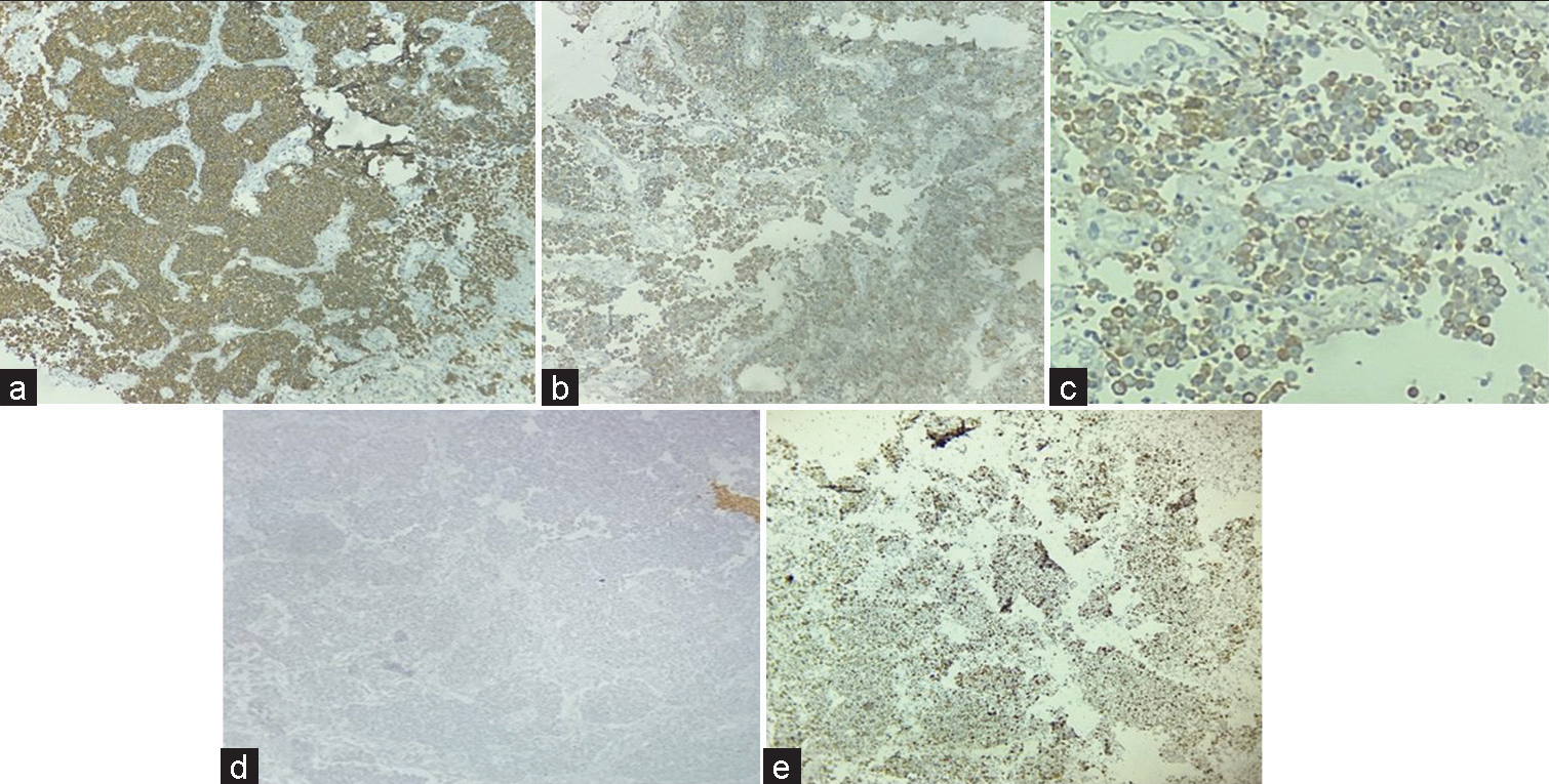 Immunohistochemistry: Strong positive synaptophysin (a), Positive Chromogranin (b), Pancytokeratin focal positive (c), and Glial fibrillary acidic protein negative (d), Ki67 >20% (e) (×40).