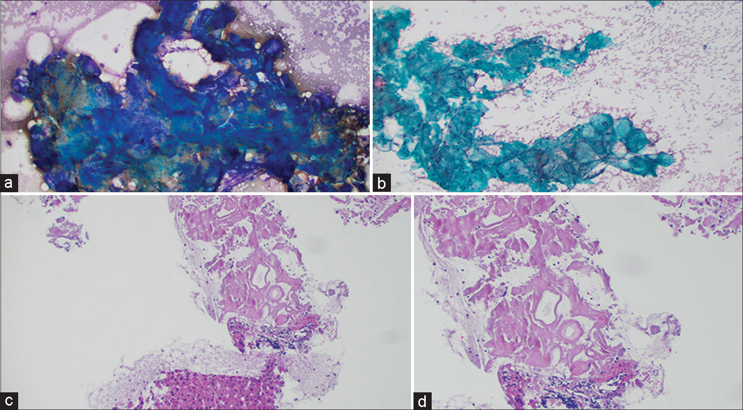 (a) Retroperitoneal fine-needle aspiration (FNA): Diff Quik Stain showing acellular, blue, amorphous material. (b) Retroperitoneal FNA: Pap stain showing acellular, greenish, rounded amorphous material. (c) Retroperitoneal FNA: Cell block with H and E stain showing hyaline deposits of amorphous eosinophilic material, amidst benign liver parenchyma (Low power view). (d) Retroperitoneal FNA: Cell block with H and E stain showing hyaline deposits of amorphous eosinophilic material (High power view).