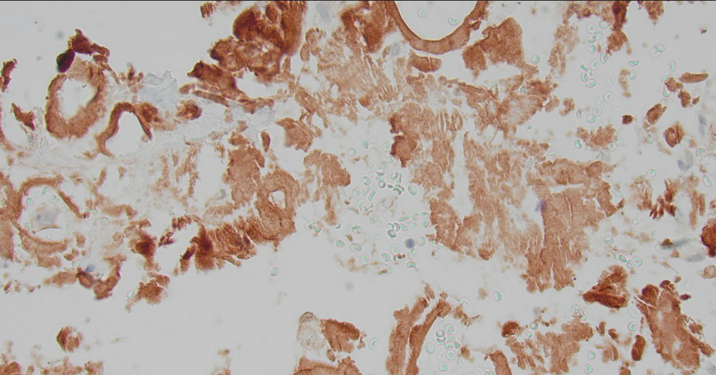 Retroperitoneal fine-needle aspiration: Congo red stain showing brownish red acellular, amorphous deposits.