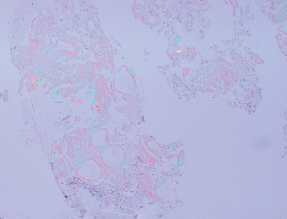 Retroperitoneal fine-needle aspiration: Congo red stain showing apple green birefringence under polarized light.