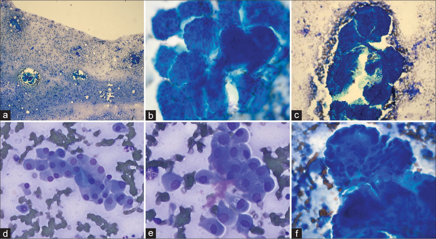 (a) Highly cellular touch preparation showing tight cohesive 3-D clusters of tumor cells and singly dispersed cells in the background. (b) The cells are arranged in 3-D clusters with variable fibrovascular cores (FCs). (c) Note the presence of characteristic FC transgressing the tumor cell cluster. (d) Background shows singly dispersed and loosely cohesive clusters of oncocytic cells with round eccentric nuclei and abundant eosinophilic granular cytoplasm. (e) Some of the single cells showed intranuclear pseudo-inclusion and bi-nucleation. (f) Note the characteristic apical localization of nuclei away from the FC.