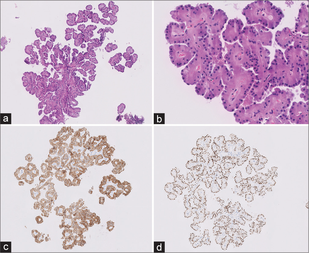 (a and b) Core-needle biopsy showing a papillary tumor with fibrovascular cores lined by single layer of cuboidal oncocytic cells. The cells show presence of round monomorphic nuclei with inconspicuous nucleoli away from the basement membrane (Hematoxylin and eosin ×10) (c and d). The tumor cells were positive for CK7 and GATA-3, respectively.